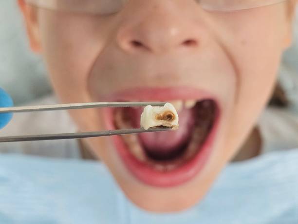 Best Emergency Treatment for Dental Infections or Abscesses in Richmond Heights, OH